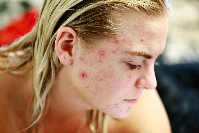 Best Treatments for Cystic Acne