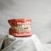 dental veneers close up