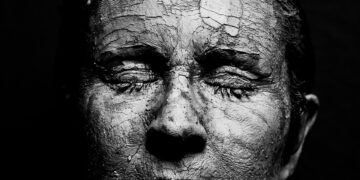 melasma skin patches