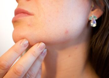 rosacea skin treatment