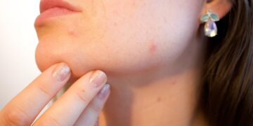 rosacea skin treatment