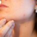 rosacea skin treatment