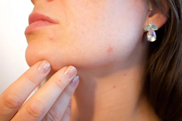 A close-up of a woman touching acne blemishes on her chin